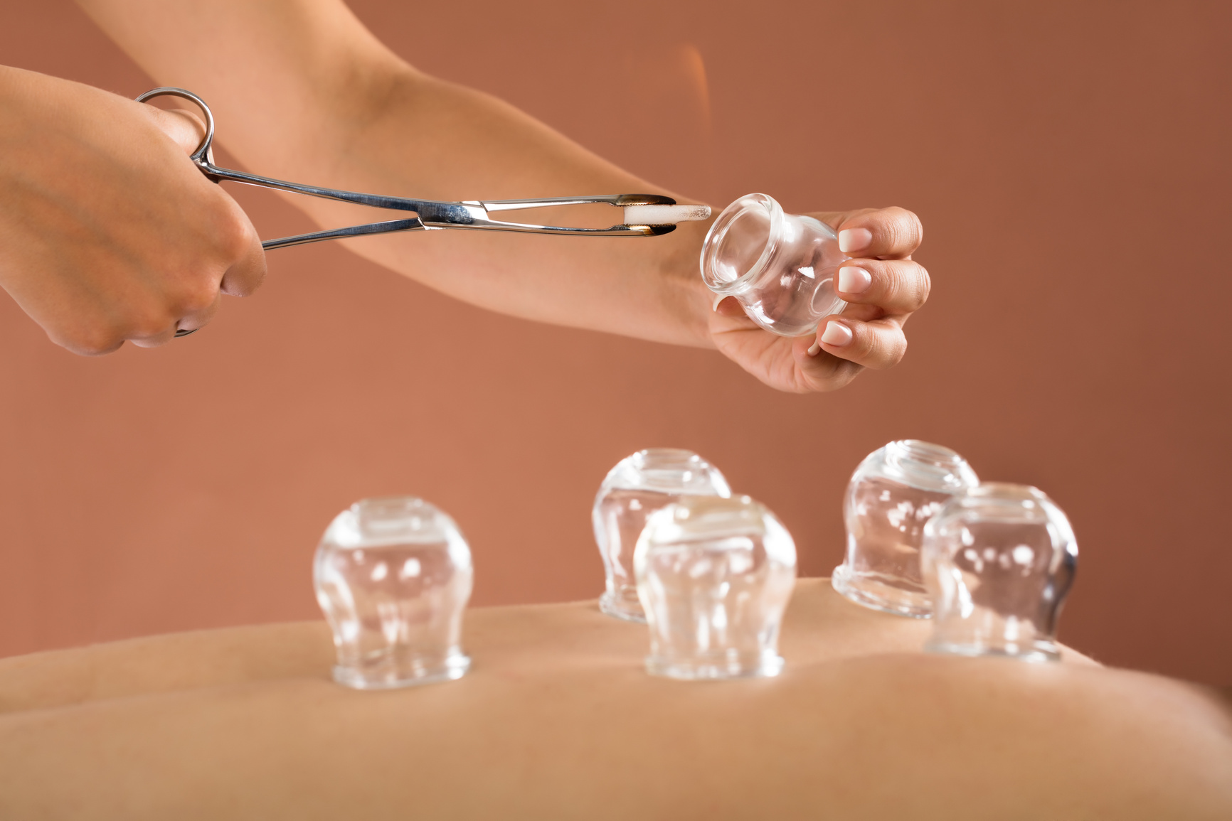 Therapist Giving Cupping Therapy To Man