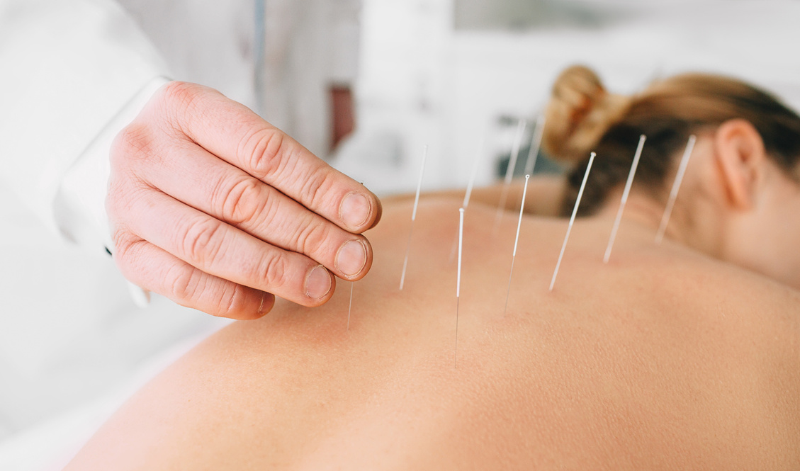 Woman having acupuncture treatment on her back